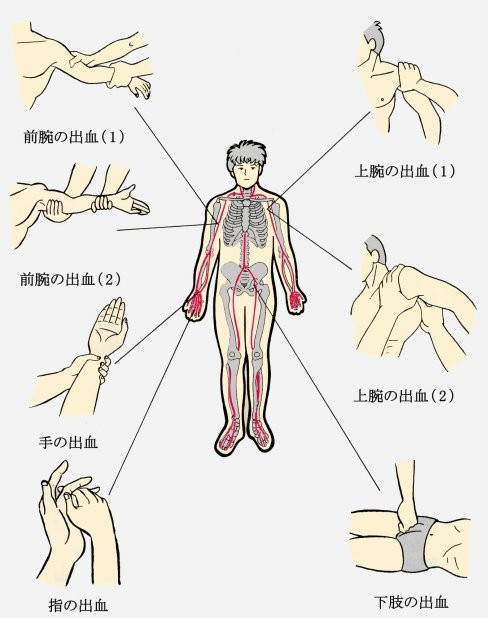 止血.JPG